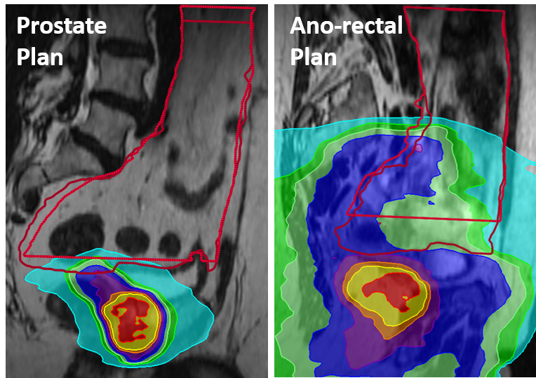 prostate and ano-rectal plan 